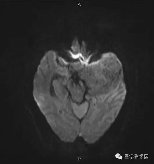 【病例】鞍旁海绵状血管瘤1例CT及MR影像表现 【病例】鞍旁海绵状血管瘤1例CT及MR影像表现