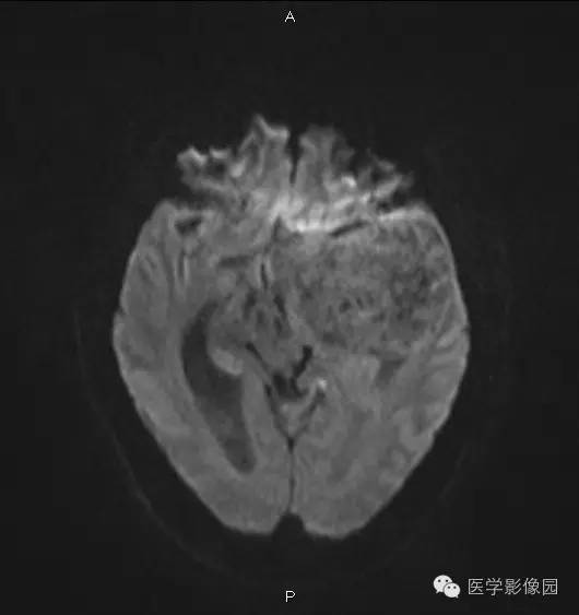 【病例】鞍旁海绵状血管瘤1例CT及MR影像表现 【病例】鞍旁海绵状血管瘤1例CT及MR影像表现