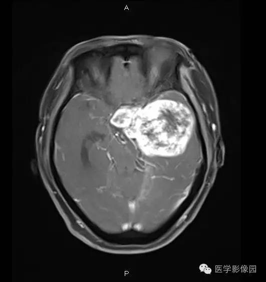 【病例】鞍旁海绵状血管瘤1例CT及MR影像表现 【病例】鞍旁海绵状血管瘤1例CT及MR影像表现