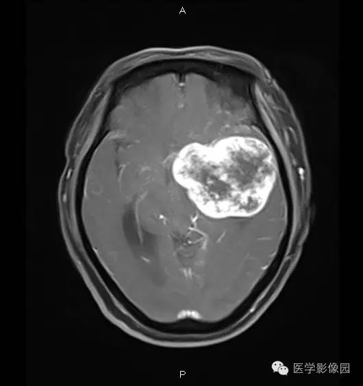 【病例】鞍旁海绵状血管瘤1例CT及MR影像表现 【病例】鞍旁海绵状血管瘤1例CT及MR影像表现