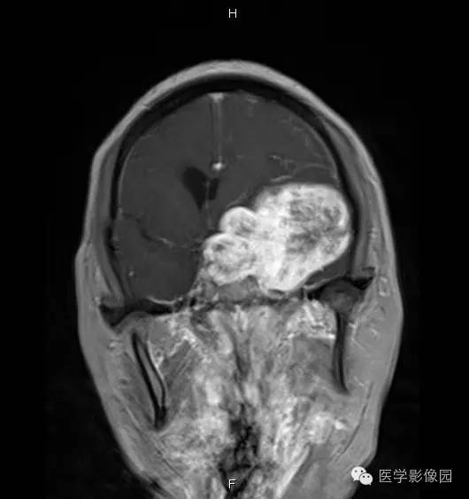 【病例】鞍旁海绵状血管瘤1例CT及MR影像表现 【病例】鞍旁海绵状血管瘤1例CT及MR影像表现