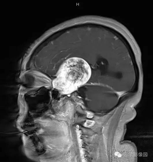 【病例】鞍旁海绵状血管瘤1例CT及MR影像表现 【病例】鞍旁海绵状血管瘤1例CT及MR影像表现