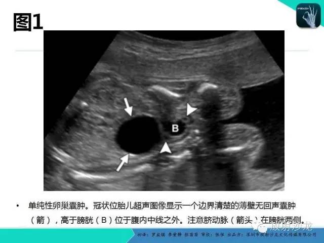 【PPT】胎儿卵巢囊肿：成像序列、鉴别诊断、治疗和结局综述