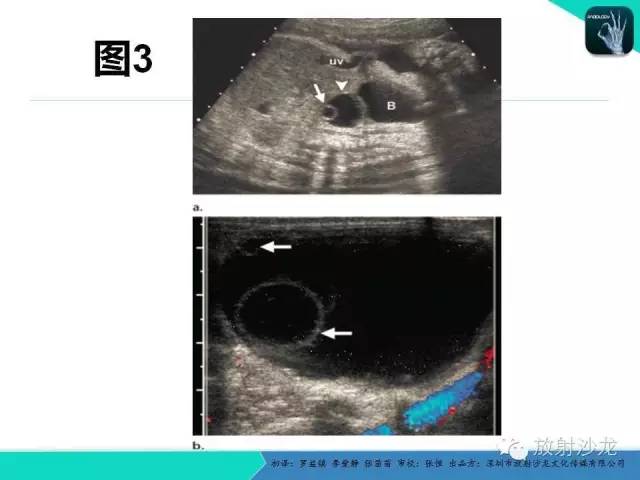 【PPT】胎儿卵巢囊肿：成像序列、鉴别诊断、治疗和结局综述