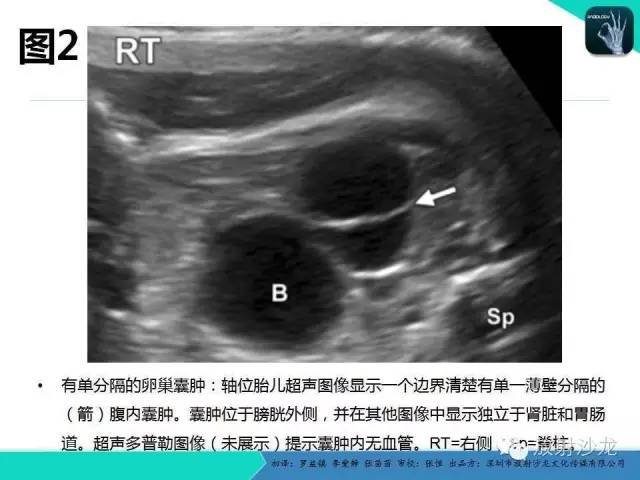 【PPT】胎儿卵巢囊肿：成像序列、鉴别诊断、治疗和结局综述
