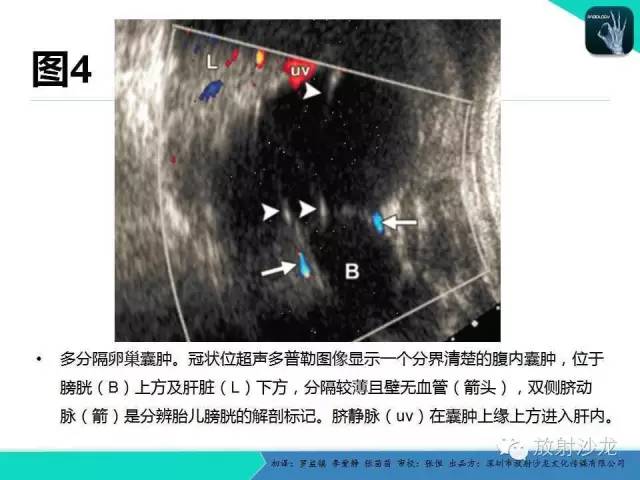 【PPT】胎儿卵巢囊肿：成像序列、鉴别诊断、治疗和结局综述