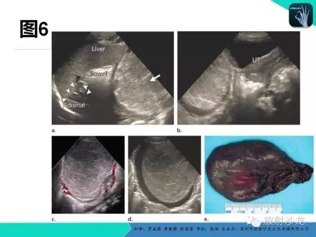 【PPT】胎儿卵巢囊肿：成像序列、鉴别诊断、治疗和结局综述