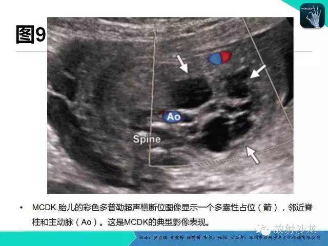 【PPT】胎儿卵巢囊肿：成像序列、鉴别诊断、治疗和结局综述