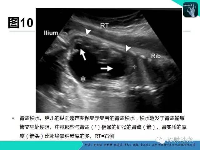 【PPT】胎儿卵巢囊肿：成像序列、鉴别诊断、治疗和结局综述