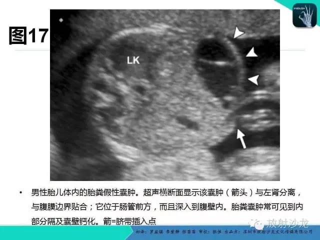 【PPT】胎儿卵巢囊肿：成像序列、鉴别诊断、治疗和结局综述