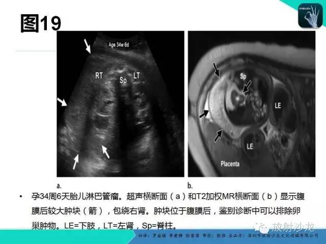 【PPT】胎儿卵巢囊肿：成像序列、鉴别诊断、治疗和结局综述