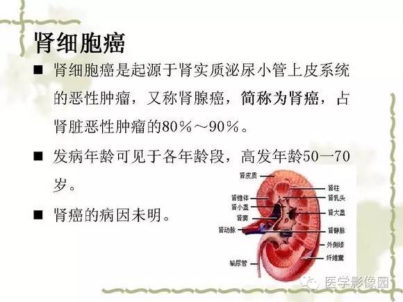【PPT】肾癌的影像学表现