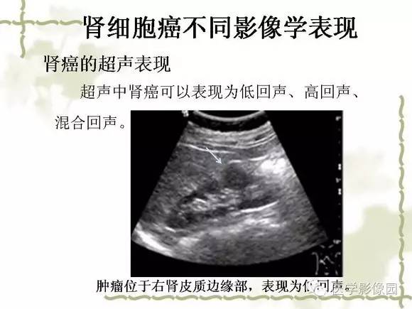 【PPT】肾癌的影像学表现