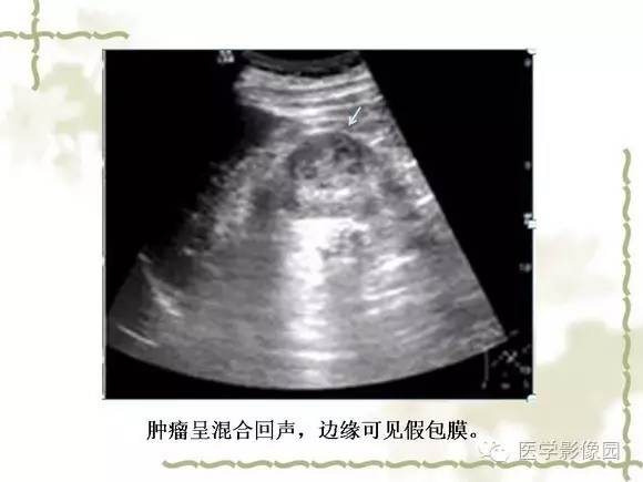 【PPT】肾癌的影像学表现