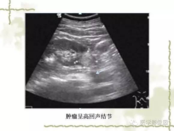 【PPT】肾癌的影像学表现
