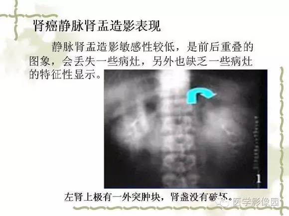 【PPT】肾癌的影像学表现