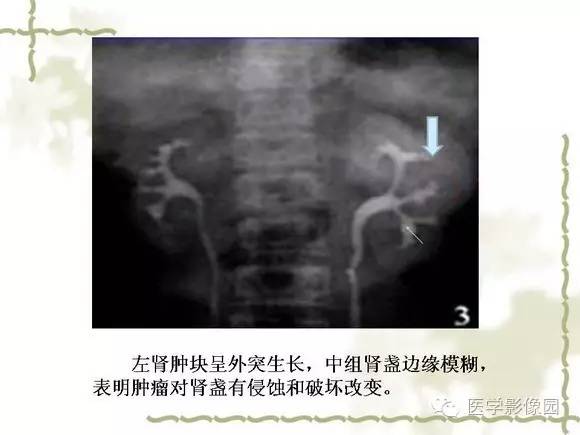 【PPT】肾癌的影像学表现