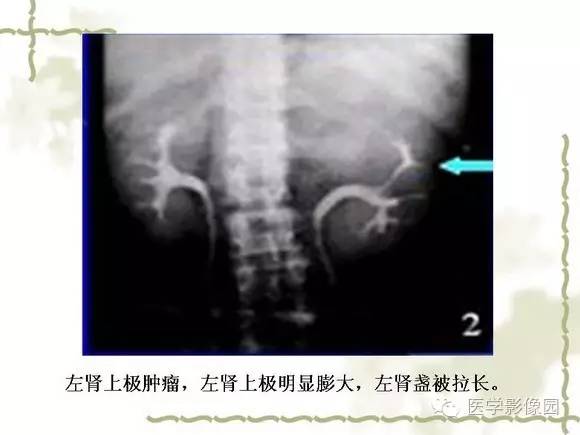 【PPT】肾癌的影像学表现