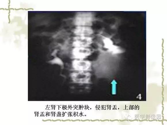 【PPT】肾癌的影像学表现