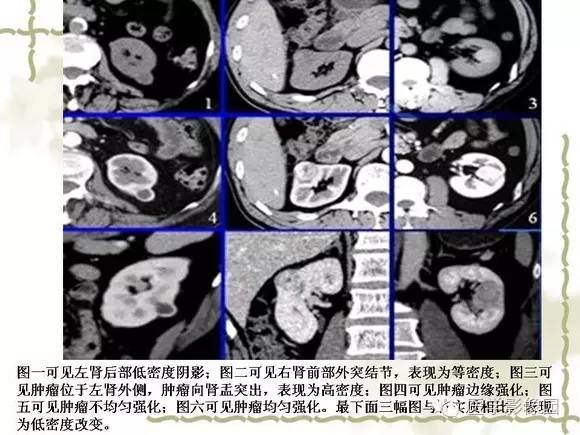 【PPT】肾癌的影像学表现