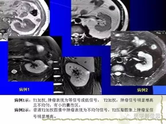 【PPT】肾癌的影像学表现