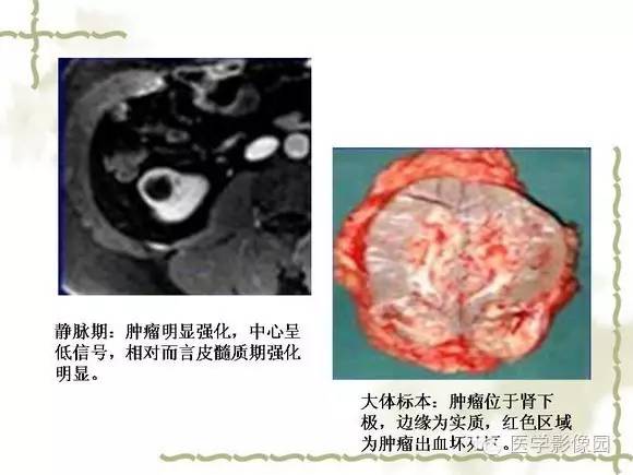 【PPT】肾癌的影像学表现