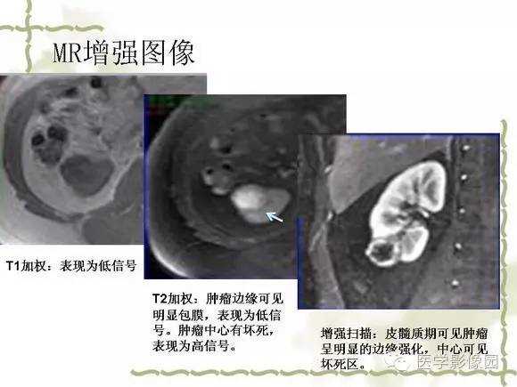 【PPT】肾癌的影像学表现