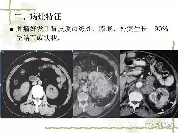 【PPT】肾癌的影像学表现