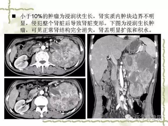 【PPT】肾癌的影像学表现