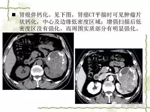 【PPT】肾癌的影像学表现