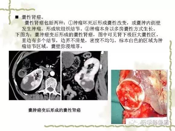 【PPT】肾癌的影像学表现