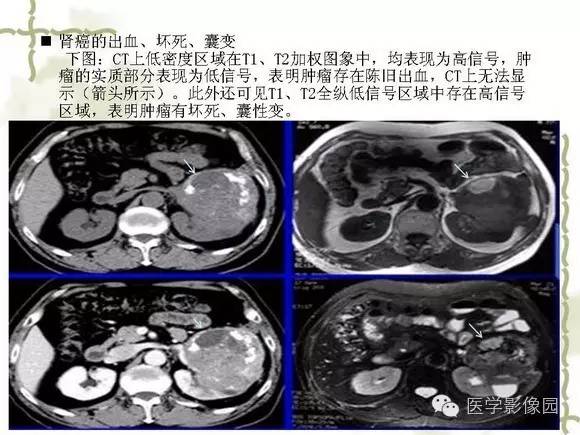 【PPT】肾癌的影像学表现