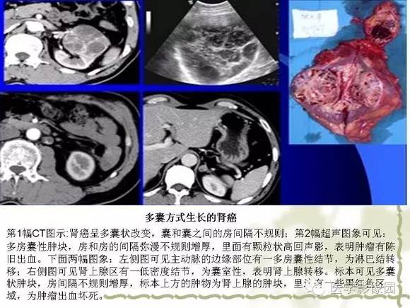 【PPT】肾癌的影像学表现