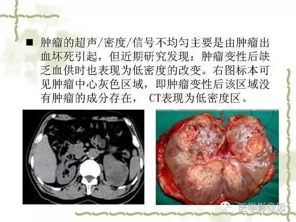 【PPT】肾癌的影像学表现