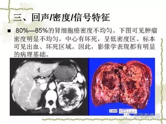 【PPT】肾癌的影像学表现