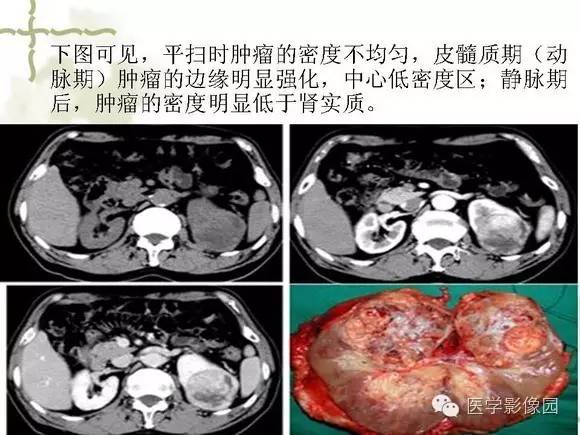 【PPT】肾癌的影像学表现