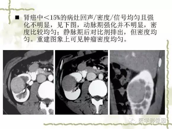【PPT】肾癌的影像学表现