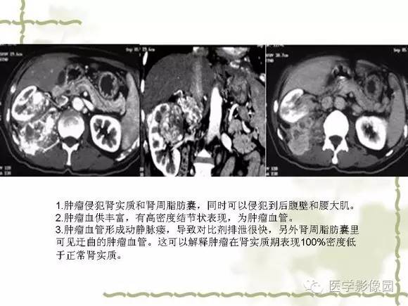 【PPT】肾癌的影像学表现