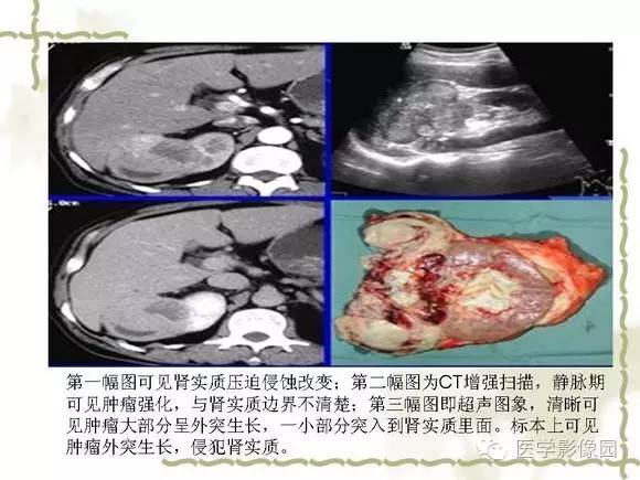 【PPT】肾癌的影像学表现