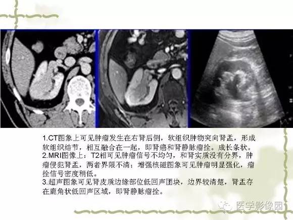 【PPT】肾癌的影像学表现