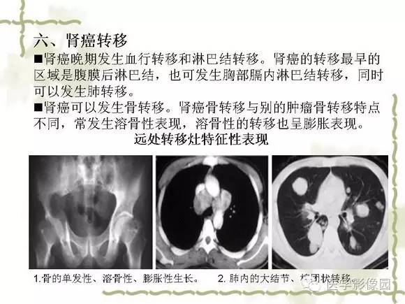 【PPT】肾癌的影像学表现