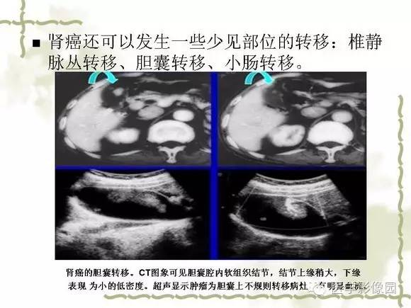 【PPT】肾癌的影像学表现