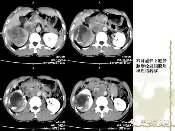 【PPT】肾癌的影像学表现