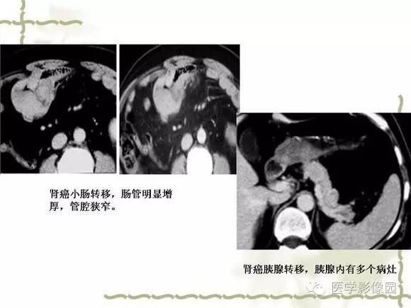 【PPT】肾癌的影像学表现