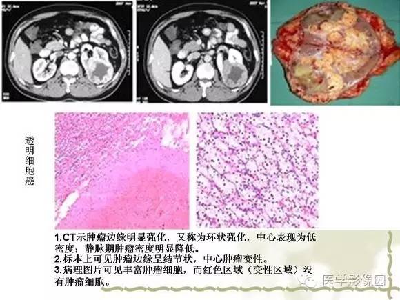 【PPT】肾癌的影像学表现