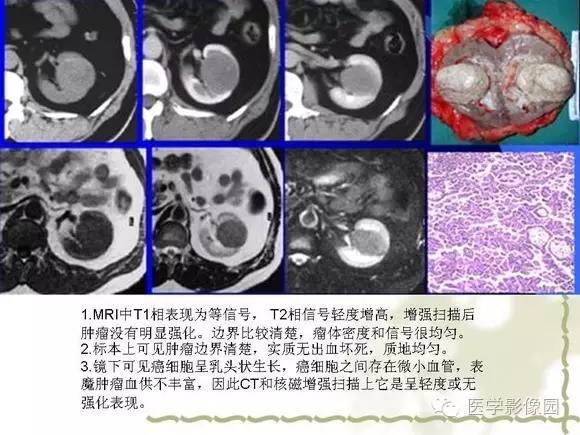 【PPT】肾癌的影像学表现