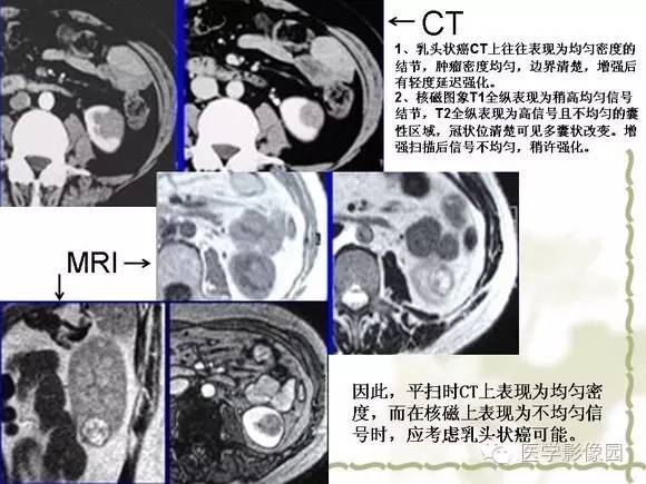 【PPT】肾癌的影像学表现