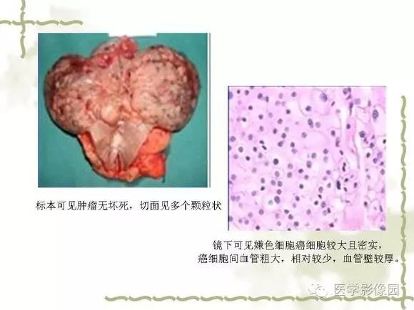 【PPT】肾癌的影像学表现