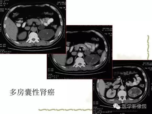 【PPT】肾癌的影像学表现