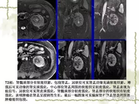 【PPT】肾癌的影像学表现